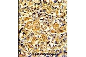 Formalin-fixed and paraffin-embedded human breast carcinoma with EGFR Monoclonal Antibody, which was peroxidase-conjugated to the secondary antibody, followed by DAB staining. (EGFR Antikörper)