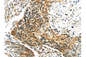 The image on the left is immunohistochemistry of paraffin-embedded Human esophagus cancer tissue using ABIN7131341(TGM4 Antibody) at dilution 1/20, on the right is treated with fusion protein. (TGM4 Antikörper)