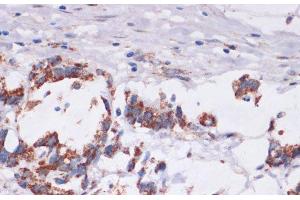 Immunohistochemistry of paraffin-embedded Human gastric cancer using DVL2 Polyclonal Antibody at dilution of 1:100 (40x lens). (DVL2 Antikörper)
