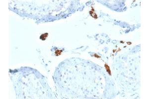 Formalin-fixed, paraffin-embedded human Testicular Carcinoma stained with Calretinin Mouse Monoclonal Antibody (CALB2/2602).