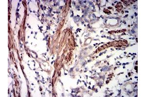 Immunohistochemical analysis of paraffin-embedded rectum cancer tissues using ACTA2 mouse mAb with DAB staining. (Smooth Muscle Actin Antikörper  (AA 2-124))