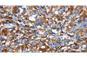 Immunohistochemistry of paraffin-embedded Human thyroid cancer tissue using CD226 Polyclonal Antibody at dilution 1:60