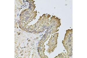 Immunohistochemistry of paraffin-embedded human prostate using PTCD3 antibody. (PTCD3 Antikörper  (AA 450-689))