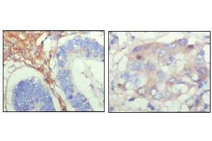 Immunohistochemical analysis of paraffin-embedded human colon cancer (left) and breast cancer (right) showing cytoplasmic localization with DAB staining using FBLN5 antibody. (Fibulin 5 Antikörper  (AA 242-448))