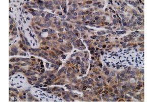 Immunohistochemical staining of paraffin-embedded Carcinoma of Human lung tissue using anti-NT5DC1 mouse monoclonal antibody. (NT5DC1 Antikörper)