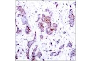 Immunohistochemistry analysis of paraffin-embedded human breast carcinoma tissue, using Rel (Ab-503) Antibody. (c-Rel Antikörper  (AA 470-519))