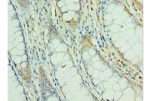 Immunohistochemistry of paraffin-embedded human colon cancer using ABIN7160504 at dilution of 1:100 (MEF2C Antikörper  (AA 170-380))