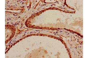 Immunohistochemistry of paraffin-embedded human prostate cancer using ABIN7169511 at dilution of 1:100 (SHC1 Antikörper  (AA 207-370))