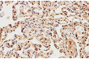 Immunohistochemistry of paraffin-embedded Human lung using IMP3 Polyclonal Antibody at dilution of 1:200 (IMP3 Antikörper)