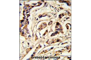 Formalin-fixed and paraffin-embedded human breast carcinoma reacted with TSHB Antibody , which was peroxidase-conjugated to the secondary antibody, followed by DAB staining. (TSHB Antikörper  (AA 58-86))