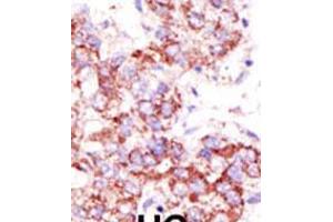Formalin-fixed and paraffin-embedded human cancer tissue reacted with the primary antibody, which was peroxidase-conjugated to the secondary antibody, followed by AEC staining. (USP4 Antikörper  (C-Term))