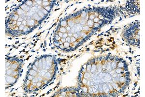 ABIN6261833 and ABIN6273246 at 1/100 staining Human colorectal cancer by IHC-P.
