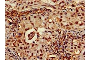Immunohistochemistry of paraffin-embedded human lung cancer using ABIN7167701 at dilution of 1:100 (RPA1 Antikörper  (AA 2-616))