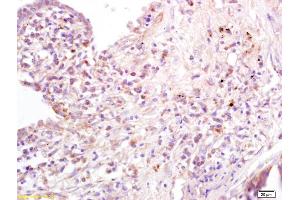 Formalin-fixed and paraffin embedded human lung carcinoma labeled with Anti-B7-1/CD80 Polyclonal Antibody, Unconjugated at 1:200 followed by conjugation to the secondary antibody and DAB staining (CD80 Antikörper  (AA 251-321))