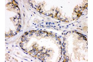 Anti- SAP97 Picoband antibody, IHC(P) IHC(P): Human Prostatic Cancer Tissue (DLG1 Antikörper  (AA 1-165))
