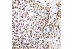 Immunohistochemistry of paraffin-embedded human well-differentiated squamous skin carcinoma using PHIP antibody (ABIN6129078, ABIN6145556, ABIN6145557 and ABIN6223036) at dilution of 1:100 (40x lens). (PHIP Antikörper  (AA 1542-1821))