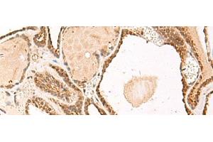 Immunohistochemistry of paraffin-embedded Human thyroid cancer tissue using FUNDC2 Polyclonal Antibody at dilution of 1:50(x200)