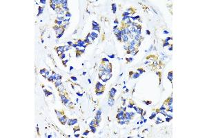 Immunohistochemistry of paraffin-embedded human breast cancer using MRPL45 antibody (ABIN6133218, ABIN6144020, ABIN6144021 and ABIN6217105) at dilution of 1:100 (40x lens). (MRPL45 Antikörper  (AA 57-306))