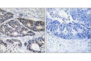 Immunohistochemistry analysis of paraffin-embedded human colon carcinoma, using Cytochrome P450 2R1 Antibody. (CYP2R1 Antikörper  (AA 251-300))
