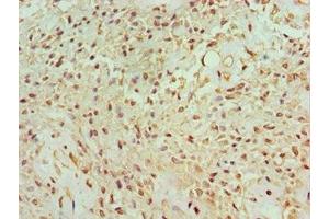 Immunohistochemistry of paraffin-embedded human breast cancer using ABIN7165122 at dilution of 1:100 (BANP Antikörper  (AA 1-260))
