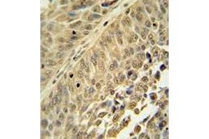 Immunohistochemistry analysis in formalin fixed and paraffin embedded human bladder carcinoma reacted with HNRNPC Antibody (C-term) followed by peroxidase conjugation of the secondary antibody and DAB staining. (HNRNPC Antikörper  (C-Term))
