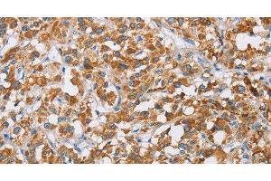 Immunohistochemistry of paraffin-embedded Human thyroid cancer tissue using BDH1 Polyclonal Antibody at dilution 1:60 (BDH1 Antikörper)