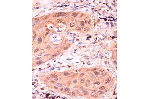 Immunohistochemistry of paraffin-embedded Human lung cancer using RPP38 Rabbit pAb (ABIN7269983) at dilution of 1:100 (40x lens). (RPP38 Antikörper  (AA 20-110))