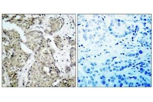 Immunohistochemical analysis of paraffin- embedded human breast carcinoma tissue, using MKK6 (phospho-Ser207) antibody (E011146). (MAP2K6 Antikörper  (pSer207))