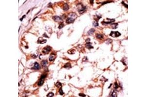 IHC analysis of FFPE human hepatocarcinoma tissue stained with the ERK3 antibody.