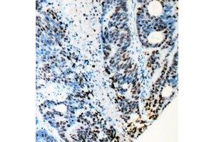 Immunohistochemical analysis of RB1 staining in human colon cancer formalin fixed paraffin embedded tissue section. (Retinoblastoma 1 Antikörper)