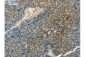The image on the left is immunohistochemistry of paraffin-embedded Human liver cancer tissue using ABIN7190467(DGKB Antibody) at dilution 1/60, on the right is treated with synthetic peptide. (DGKB Antikörper)