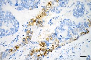Immunohistochemistry was performed on paraffin-embedded human sigmoid colon carcinoma using phospho-NDRG1 (Ser330) antibody (ABIN7799537), 1:200). (Rekombinanter NDRG1 Antikörper  (pSer330))
