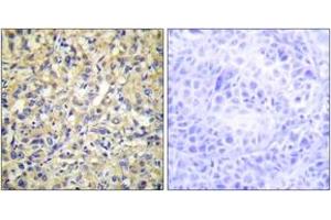 Immunohistochemistry analysis of paraffin-embedded human liver carcinoma tissue, using DUSP9 Antibody. (DUSP9 Antikörper  (AA 151-200))