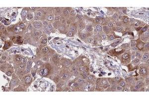 ABIN6269031 at 1/100 staining Human liver cancer tissue by IHC-P. (PDGFRA Antikörper  (C-Term))