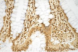Immunohistochemistry was performed on paraffin-embedded human sigmoid colon carcinoma using histone H3 (mono methyl K9) antibody (ABIN7798962), 1:200). (Rekombinanter Histone 3 Antikörper  (H3K9me1))