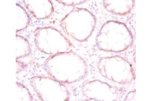 Immunohistochemistry of paraffin-embedded human colon cancer using ABIN7165284 at dilution of 1:50 (P4HB Antikörper  (AA 29-508))