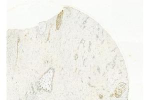 ABIN6262096 and ABIN6278471 at 1/100 staining human hepatocellular carcinoma by IHC-P. (GRO gamma Antikörper  (C-Term))