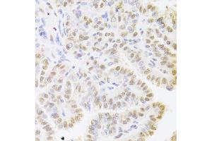 Immunohistochemistry (Paraffin-embedded Sections) (IHC (p)) image for anti-Hepatoma-Derived Growth Factor (HDGF) (AA 1-240) antibody (ABIN6141694)