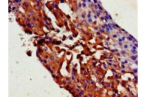 Immunohistochemistry of paraffin-embedded human breast cancer using ABIN7169527 at dilution of 1:100 (TRPC1 Antikörper  (AA 39-207))