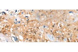 Immunohistochemistry of paraffin-embedded Human esophagus cancer tissue using CBR3 Polyclonal Antibody at dilution of 1:35(x200) (CBR3 Antikörper)