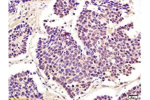 Formalin-fixed and paraffin embedded human lung carcinoma labeled with Anti-Phospho-cdc2 (Thr161) Polyclonal Antibody, Unconjugated (ABIN746978) at 1:200 followed by conjugation to the secondary antibody and DAB staining (CDK1 Antikörper  (pThr161))