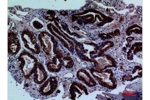 Immunohistochemistry (IHC) analysis of paraffin-embedded Human Prostate Cancer, antibody was diluted at 1:100. (LY9 Antikörper  (Internal Region))