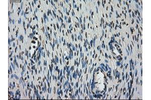 Immunohistochemical staining of paraffin-embedded Carcinoma of lung tissue using anti-STK39mouse monoclonal antibody. (STK39 Antikörper)