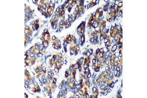 Immunohistochemistry of paraffin-embedded Human liver cancer using PLEKHB2 Rabbit pAb (ABIN7269415) at dilution of 1:100 (40x lens). (PLEKHB2 Antikörper  (AA 1-222))