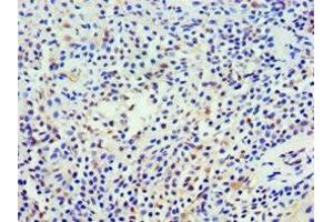 Immunohistochemistry of paraffin-embedded human breast cancer using ABIN7161360 at dilution of 1:100 (NCS1 Antikörper  (AA 1-190))