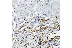 Immunohistochemistry of paraffin-embedded human liver using CD90/Thy1 Rabbit mAb (ABIN6129735, ABIN6148554, ABIN6148555 and ABIN7101405) at dilution of 1:100 (40x lens). (CD90 Antikörper)