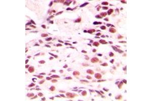 Immunohistochemical analysis of Lamin A/C staining in human breast cancer formalin fixed paraffin embedded tissue section. (Lamin A/C Antikörper  (Center))
