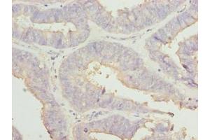 Immunohistochemistry of paraffin-embedded human endometrial cancer using ABIN7167001 at dilution of 1:100