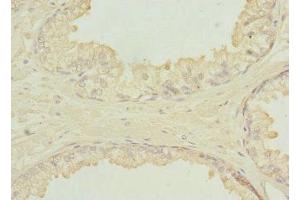 Immunohistochemistry of paraffin-embedded human prostate cancer using ABIN7151649 at dilution of 1:100 (SH3GLB2 Antikörper  (AA 1-250))