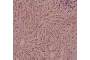 Immunohistochemistry (IHC) analyzes of CD124 / IL4R Antibody in paraffin-embedded human breast carcinoma tissue at 1/100. (IL4 Receptor Antikörper)